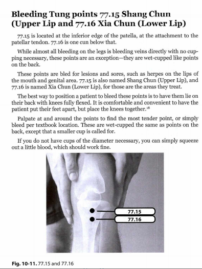 2021-06-20 17_16_07-Chinese Medicine Bloodletting.pdf and 6 more pages – Profile 1 – Microsoft​ Edge