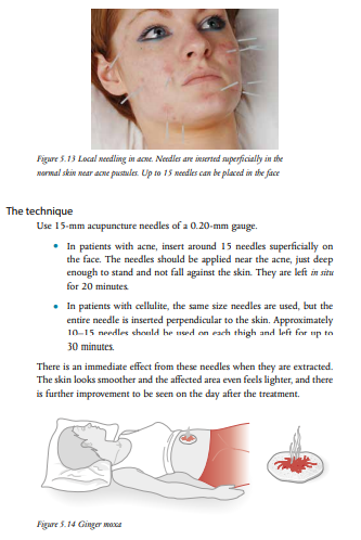 2021-06-19 19_01_25-Cosmetic Acupuncture.pdf and 4 more pages – Profile 1 – Microsoft​ Edge