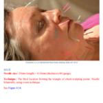 2021-06-19 19_20_55-Facial Enhancement Acupuncture.pdf and 5 more pages – Profile 1 – Microsoft​ Edg